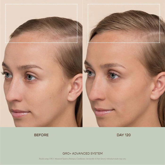 Vegamour  GRO+ Advanced Balancing Shampoo and Conditioner Set for Severe Signs of Thinning