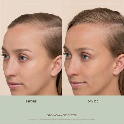Vegamour  GRO+ Advanced Balancing Shampoo and Conditioner Set for Severe Signs of Thinning